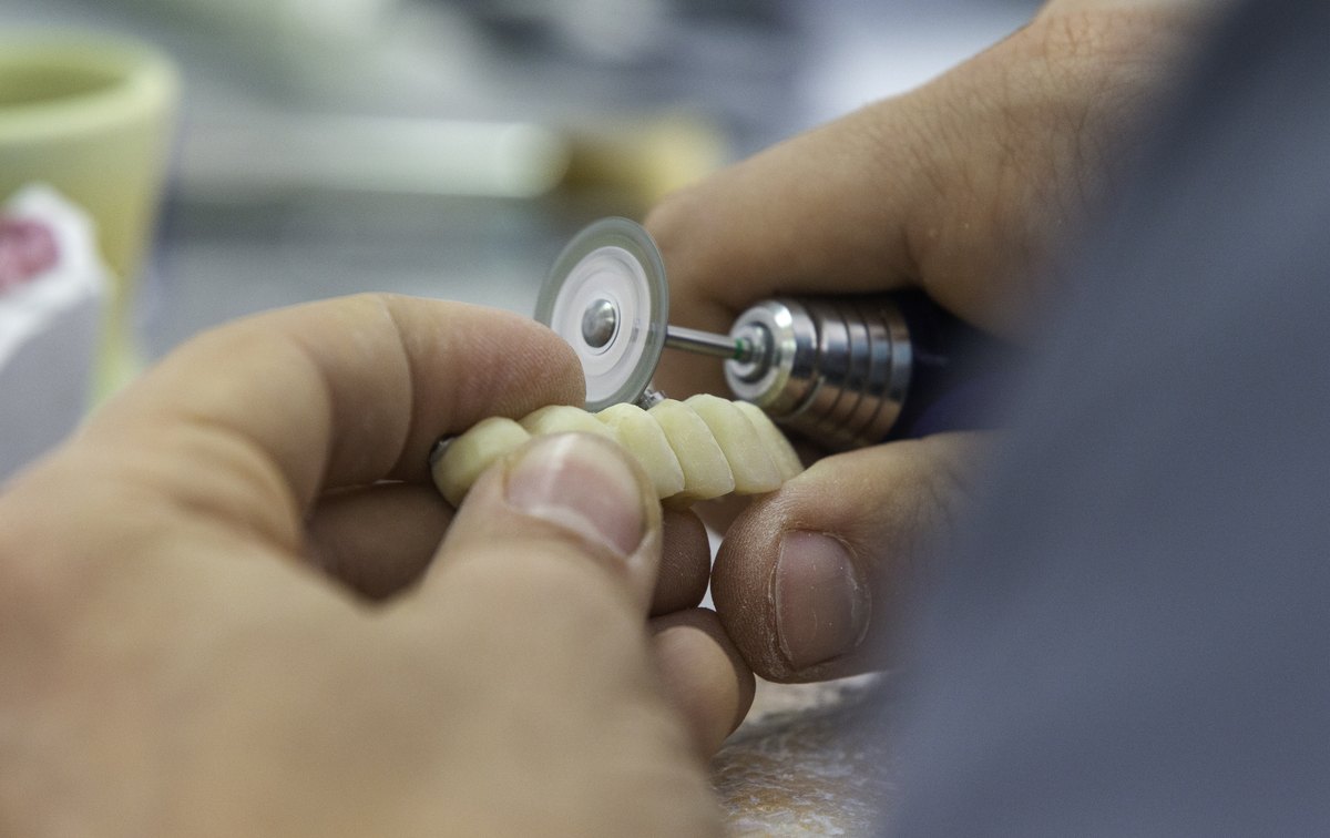 Polissage d'un bridge sur implants