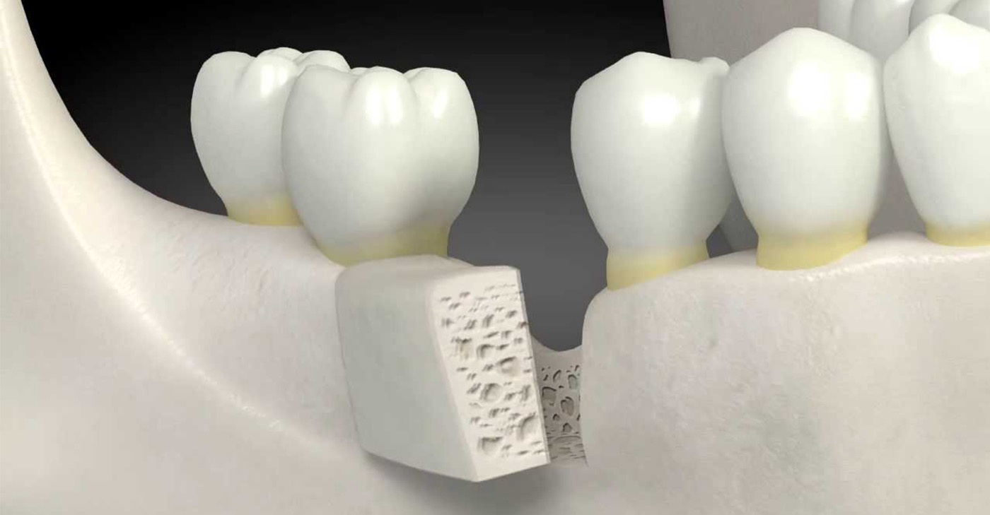 Greffe osseuse et sinus lift