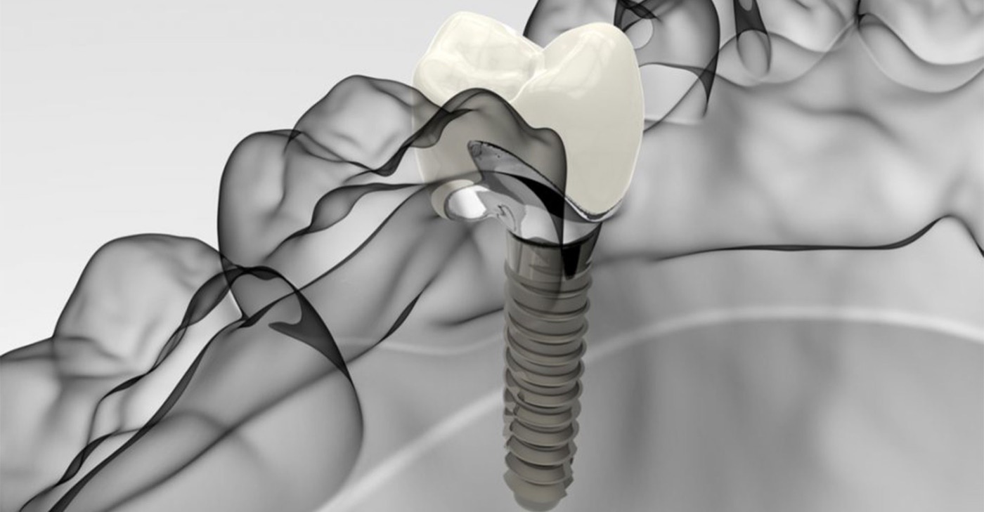 Implants dentaires