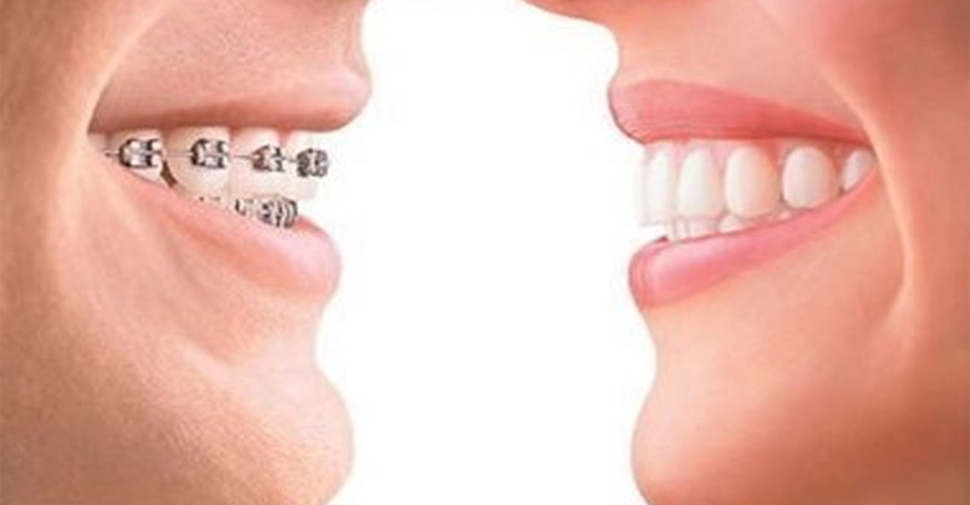Orthodontie et aligneurs