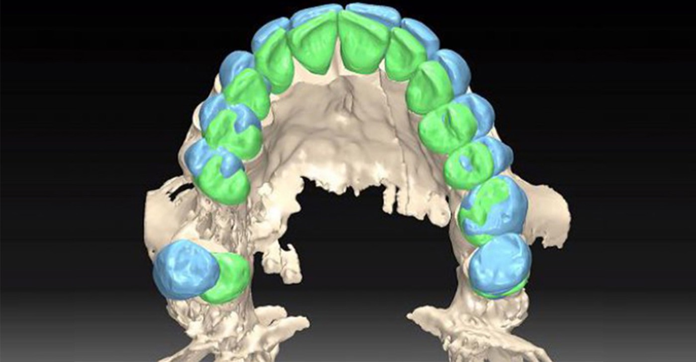 Bridge complet sur implants